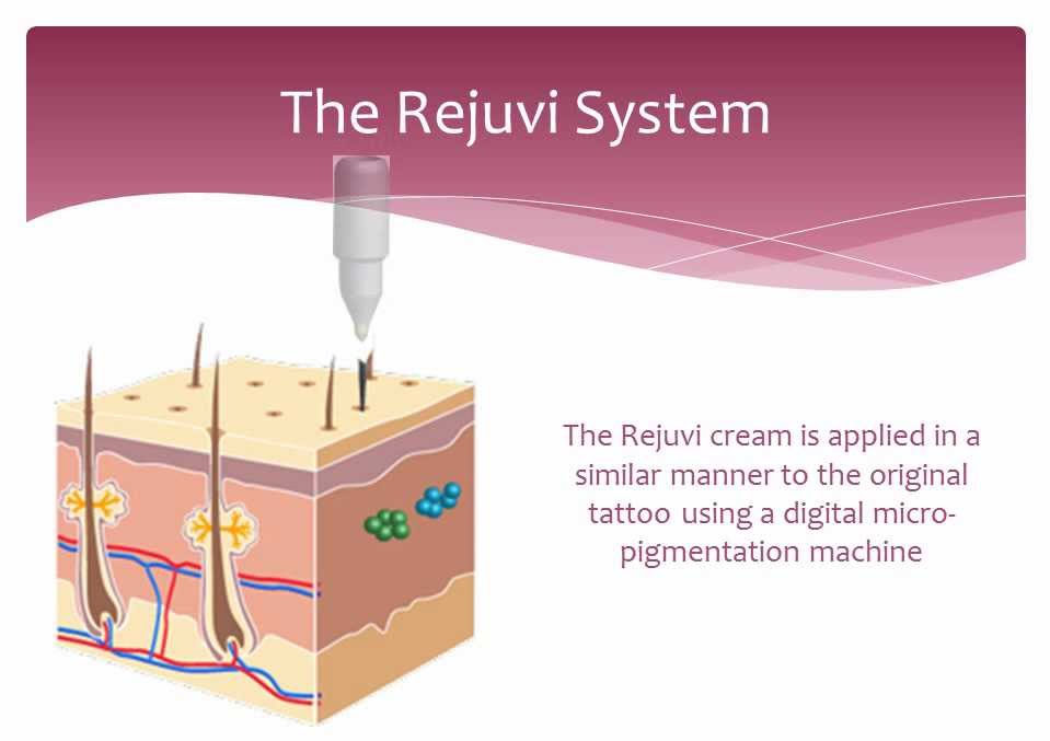 Rejuvi tattoo removal